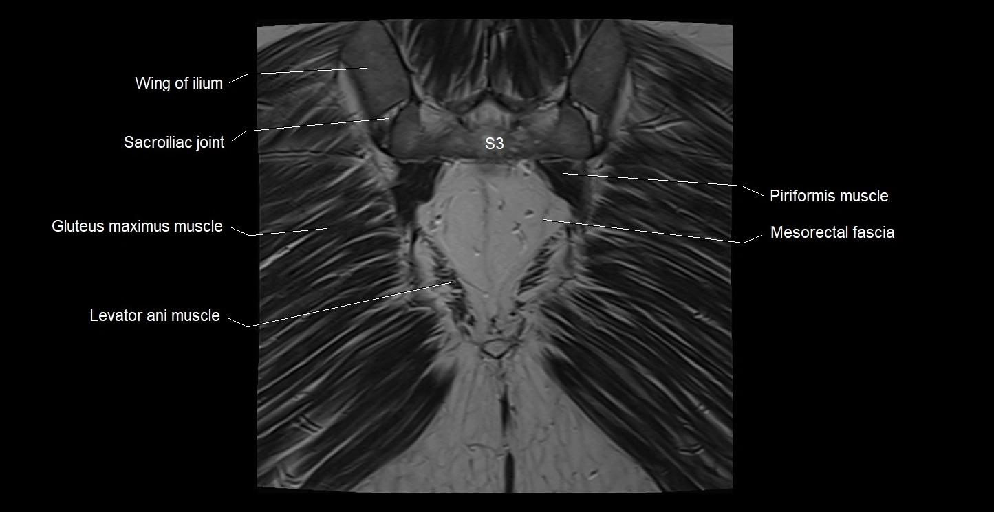 MRI coronal cross sectional anatomy male pelvis image 37.webp